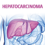 hepatocarcinoma-1